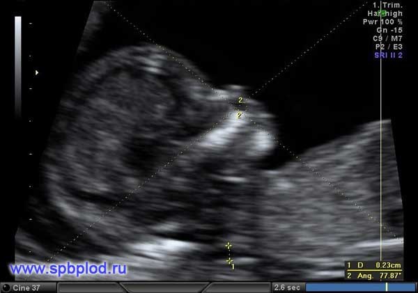 УЗИ 12 недель беременности Люберцы | клиника KRH Medical